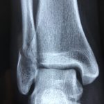 Comment savoir si on a une entorse à un doigt de pied ?